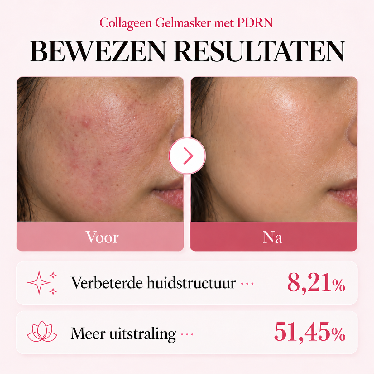 Resultaten voor en na het collageen gelmasker met PDRN